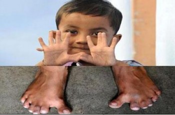 25 fingers boy in India